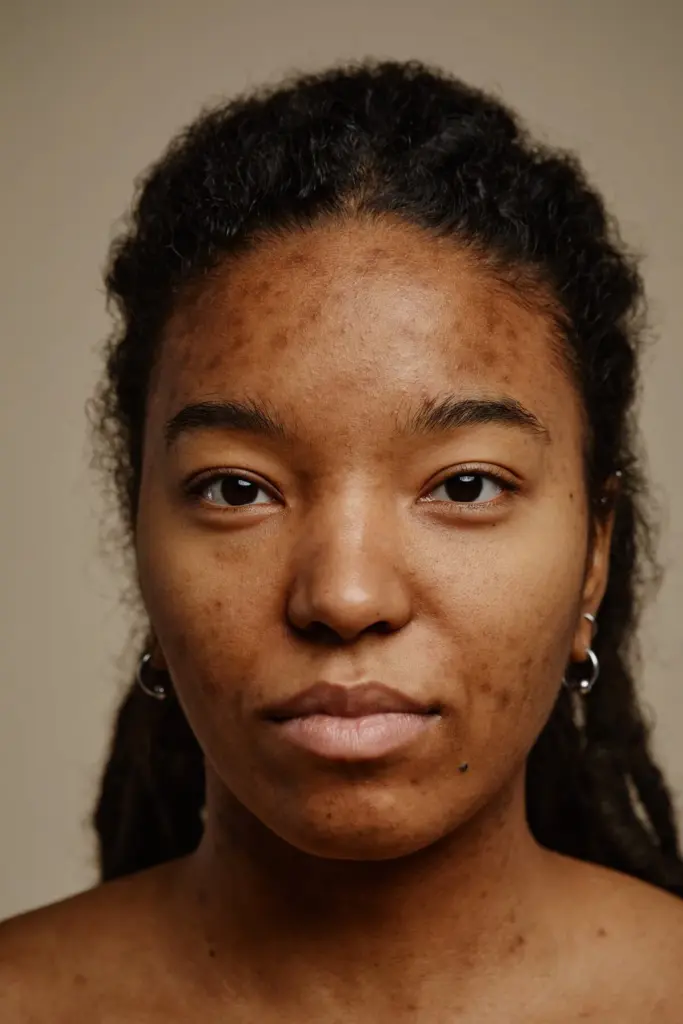 Acne Scarring and Skin Resurfacing in orlando FL