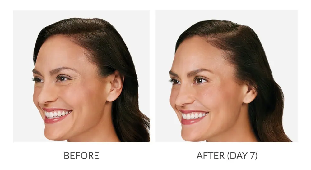 Before and After Botox Treatement a