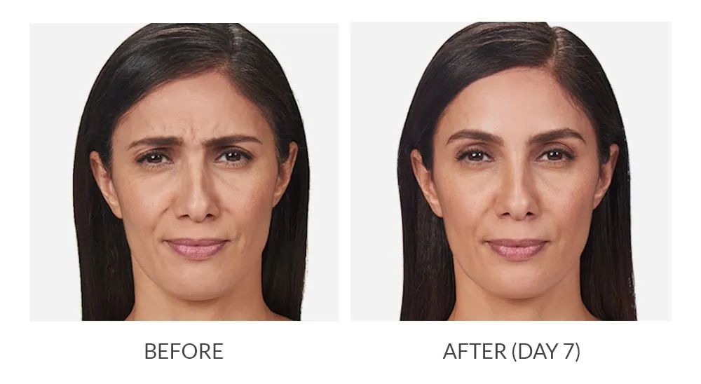 Before and After Botox Treatement b