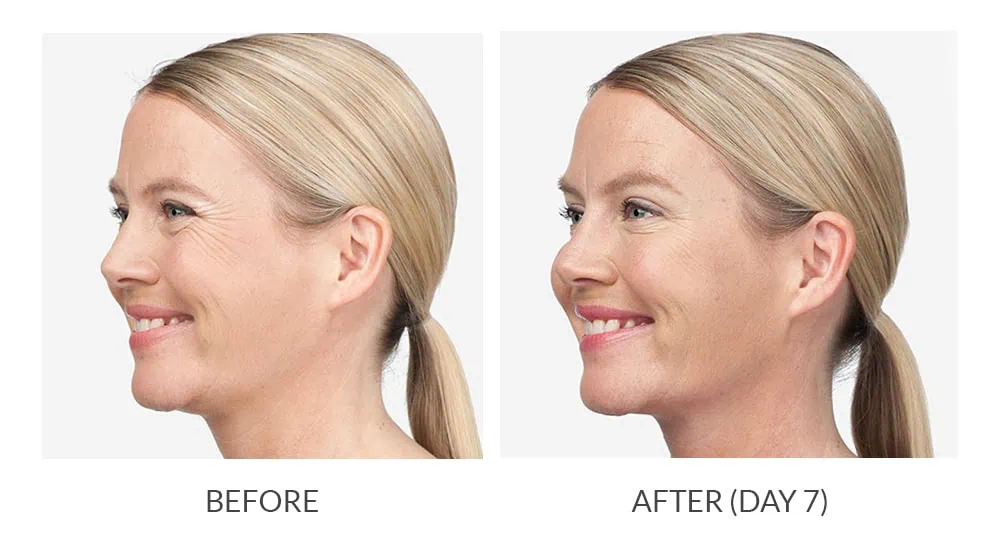 Before and After Botox Treatement c