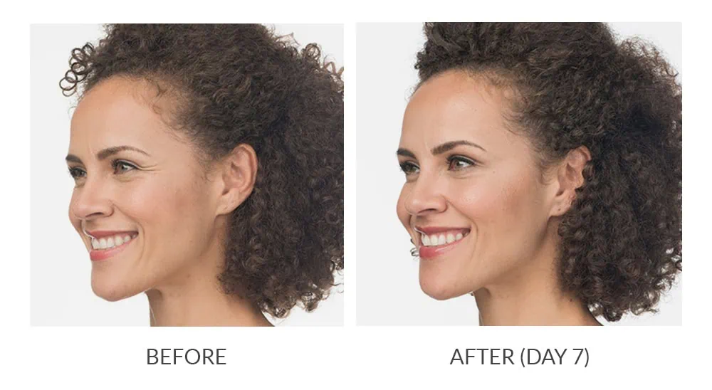 Before and After Botox Treatement e