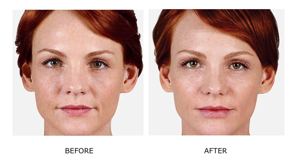 Before and After Cosmetic Fillers Treatment d