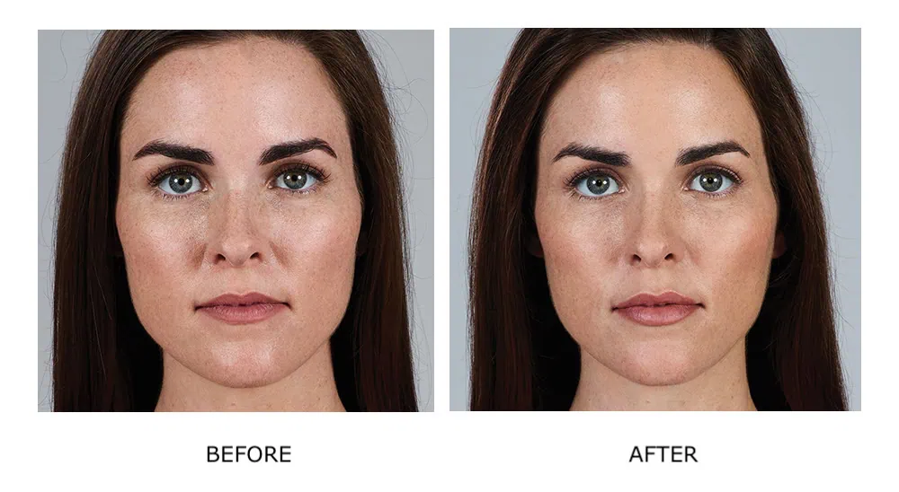 Before and After Cosmetic Fillers Treatment f