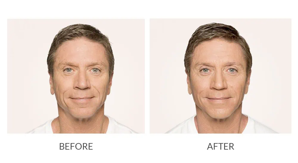 Before and After Cosmetic Fillers Treatment h