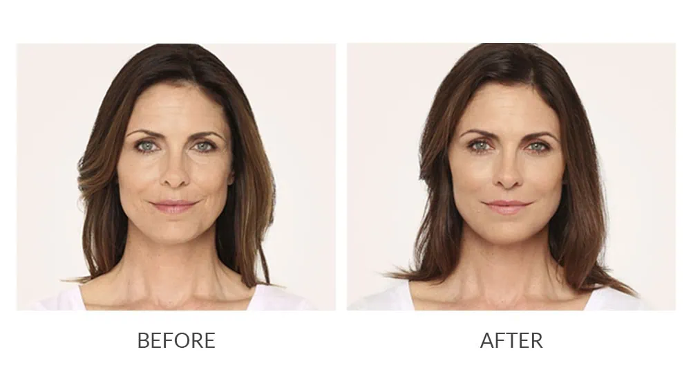 Before and After Cosmetic Fillers Treatment i