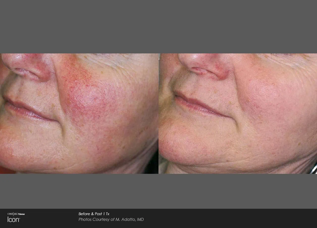 Before and After IPL Photofacial Treatment b