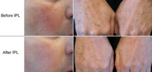 Before and after sun damage treatment results