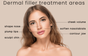 Image of dermal filler treatment areas