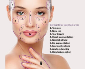 Filler markup on a woman's face