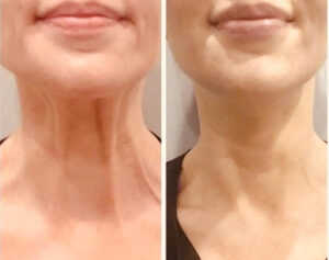 Turkey Neck before and after photos