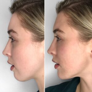 Before and after jawline treatments