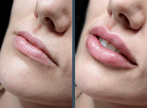 Before and after images of a woman's lips