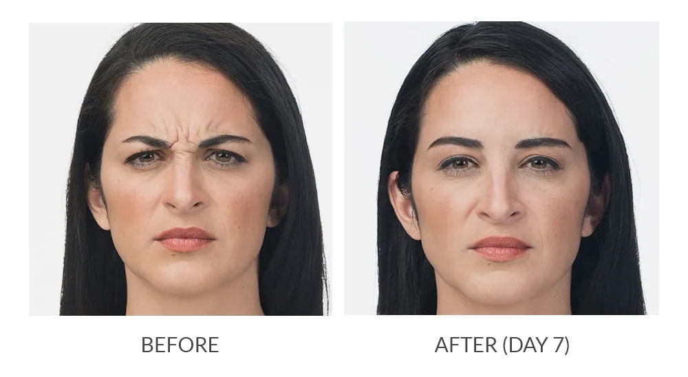 Before and After Botox Treatement d