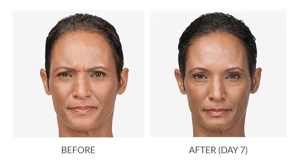 Before and After Botox Treatement