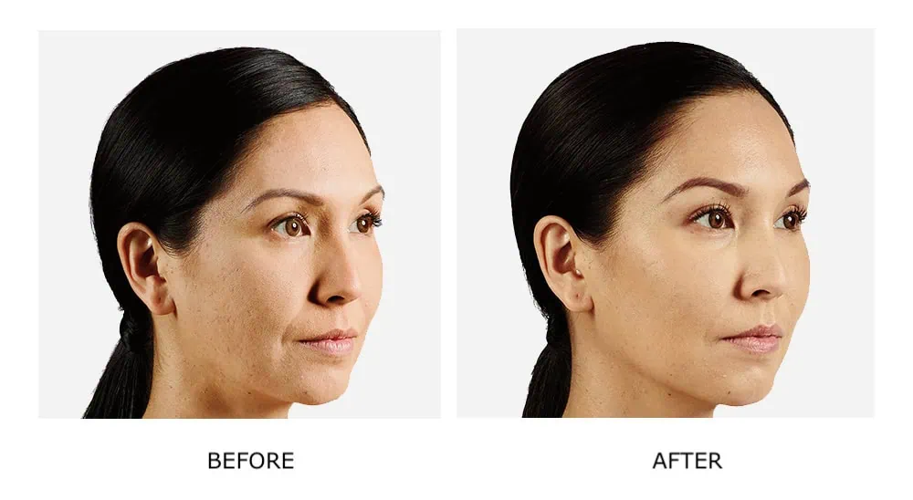 Before and After Cosmetic Fillers Treatment a