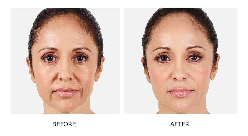Before and After Cosmetic Fillers Treatment b