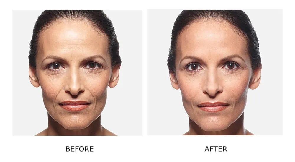 Before and After Cosmetic Fillers Treatment c