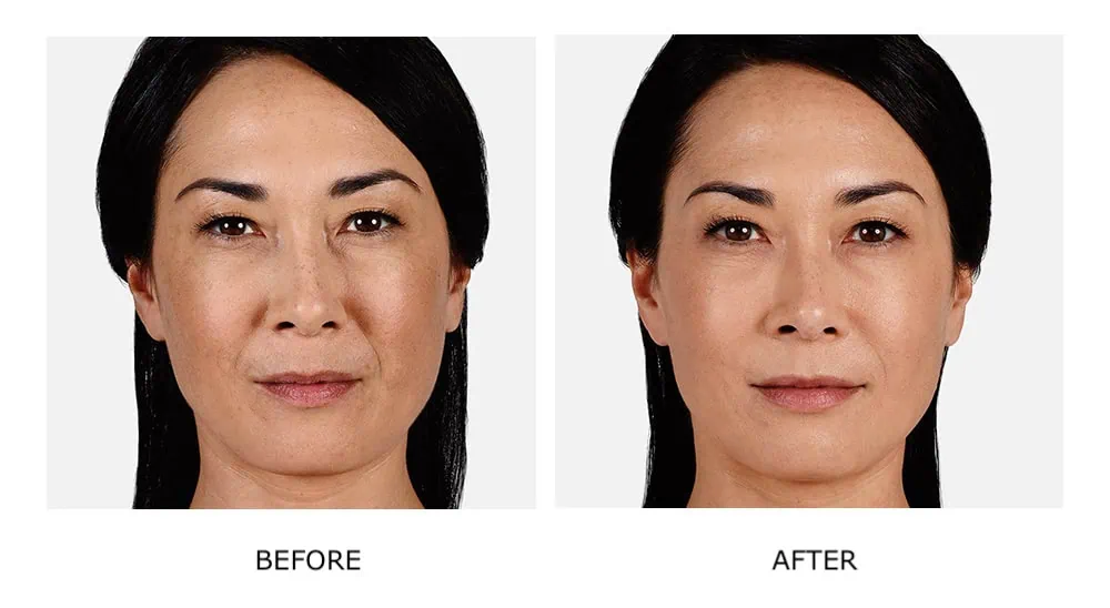 Before and After Cosmetic Fillers Treatment e'