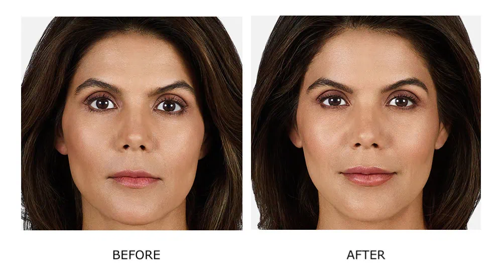 Before and After Cosmetic Fillers Treatment g