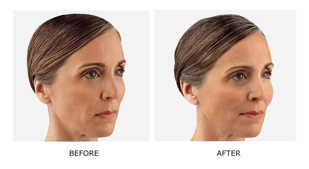 Before and After Cosmetic Fillers Treatment
