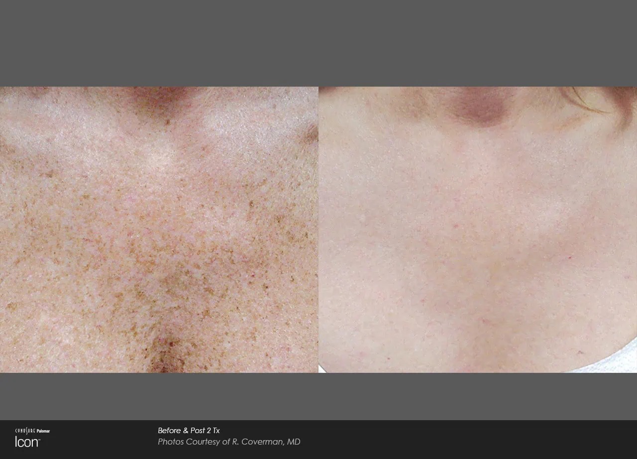 Before and After IPL Photofacial Treatment a
