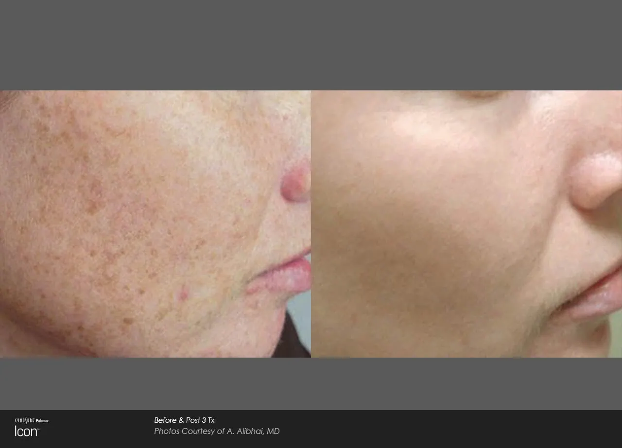 Before and After IPL Photofacial Treatment