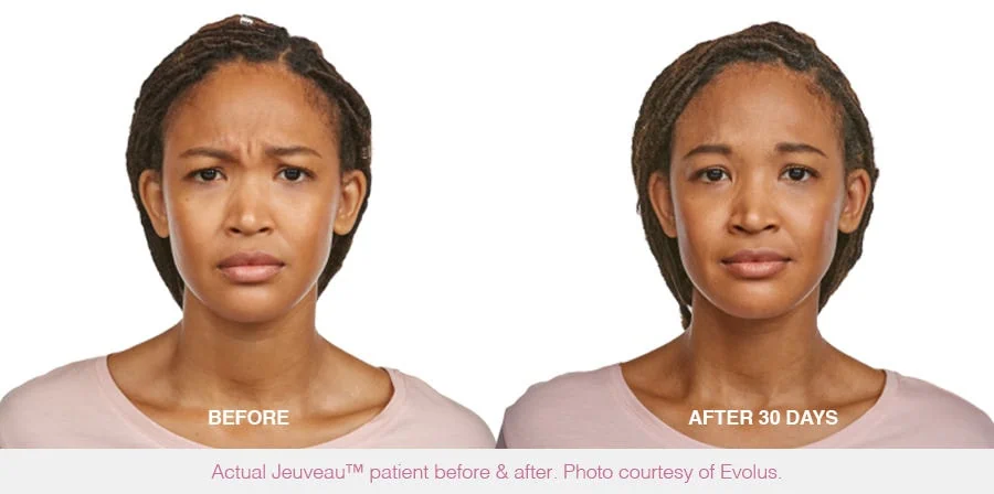 Before and After Jeuveau Treatment a