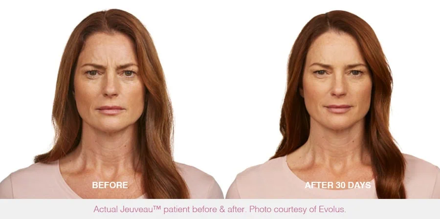 Before and After Jeuveau Treatment